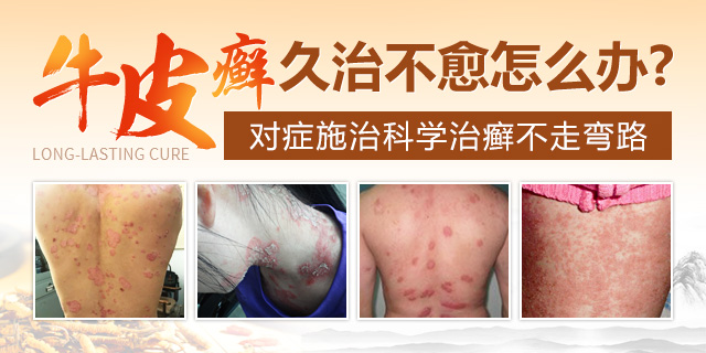 银屑病患者如何应对下雨天